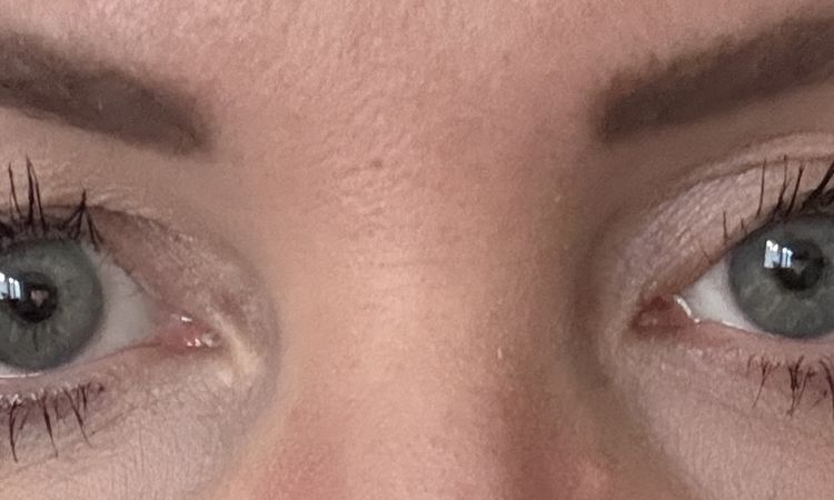 Tränen Prolabs, Augenlidkorrektur - 82960