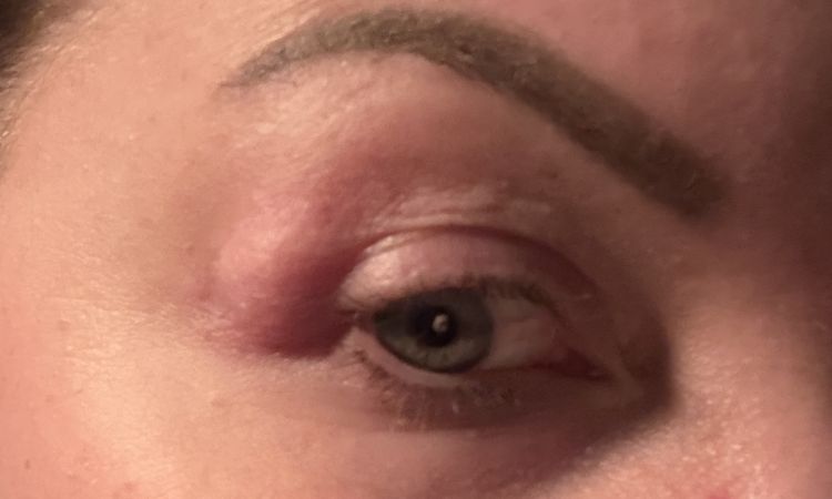 Tränen Prolabs, Augenlidkorrektur - 82961