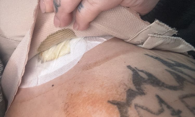 Brustverkleinerung Wundwasser im BH - 82973