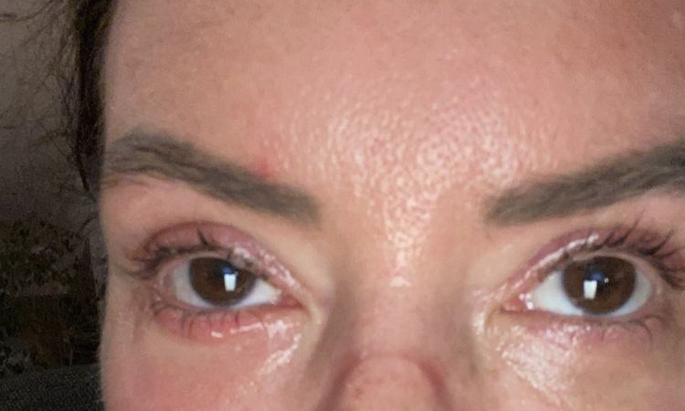 Probleme nach Ober-und Unterlidstraffung - 82983