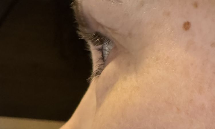 Geschwollene Unterlider nach Sculptra - 82984