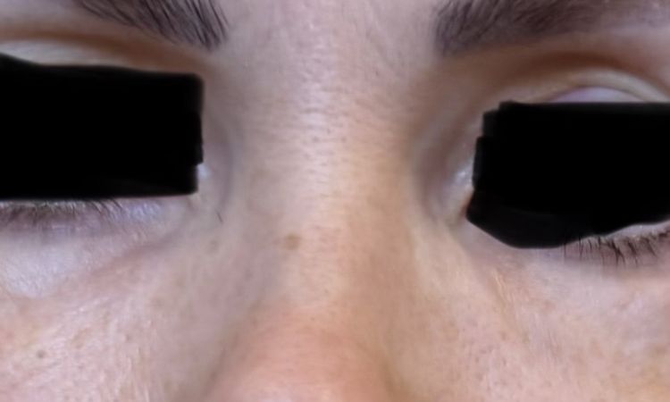 Geschwollene Unterlider nach Sculptra - 82985