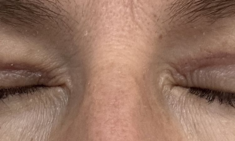 Augenlid schließt nicht richtig nach Oberlid OP - 83004