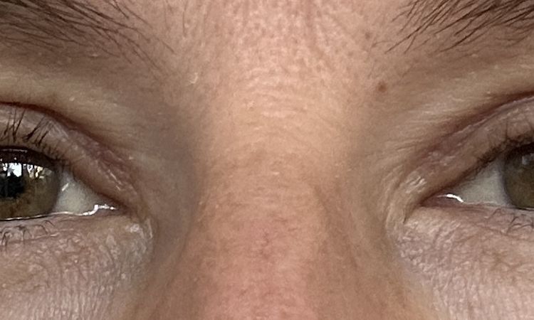 Augenlid schließt nicht richtig nach Oberlid OP - 83005