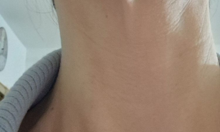 Platysma Straffung Nahtmaterial - 83012