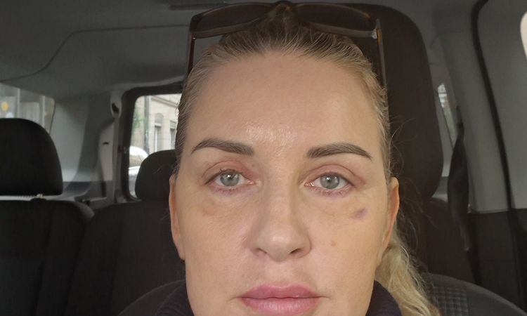 Asymmetrie  nach oberen  Lidstraffung - 83013