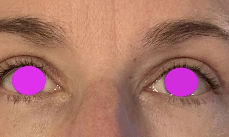 Augenlid schließt nicht vollständig nach Oberlidstraffung - 83015