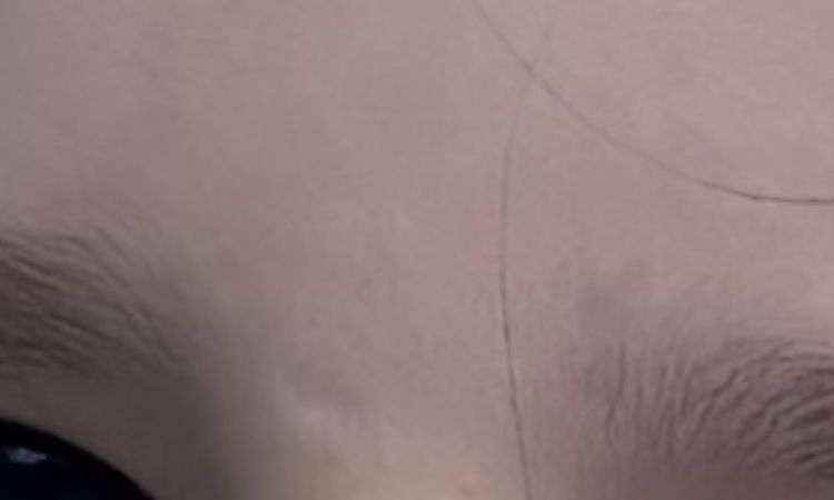 2 kleine Narben im Gesicht - 83017