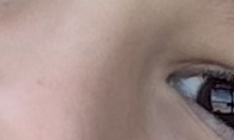 2 kleine Narben im Gesicht - 83018