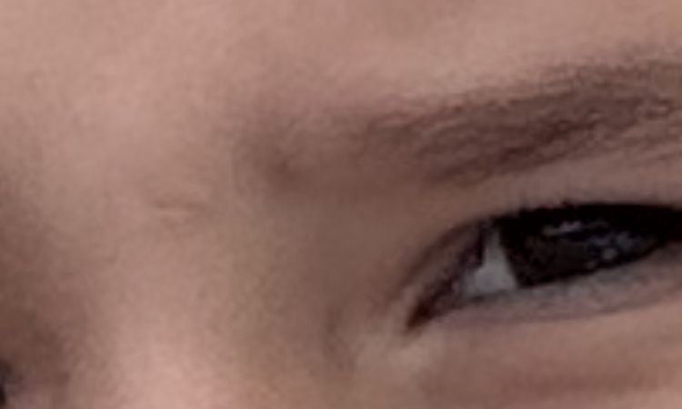 2 kleine Narben im Gesicht - 83019