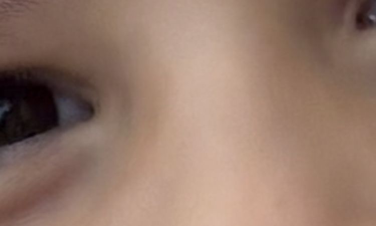 2 kleine Narben im Gesicht - 83020