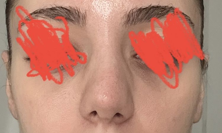 Schiefe nase nach Operation (ca 5 wochen her) - 83036