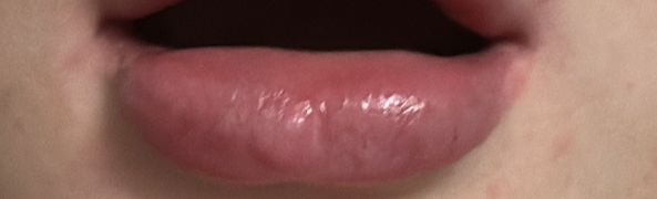 Lippen lassen sich durch Hylase nicht auflösen - 83039