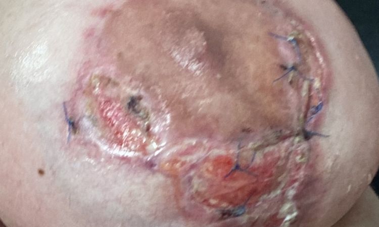 Wundheilung nach Brustvergrösserung & Straffung - 83040