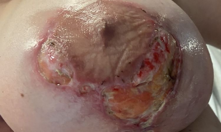 Wundheilung nach Brustvergrösserung & Straffung - 83042
