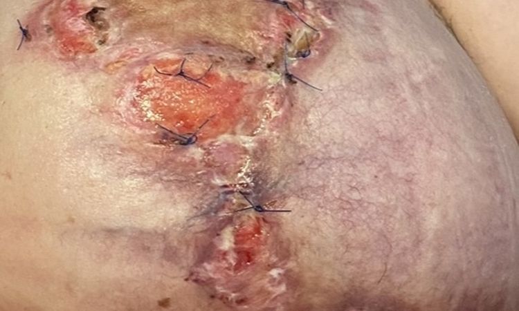 Wundheilung nach Brustvergrösserung & Straffung - 83043
