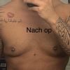 Mini BDS mit 360 vaser lipo