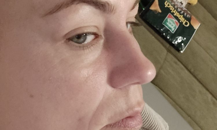 Hyaluronsäure in der Nasialfalten vor 3 Wochen gespritzt - 83074