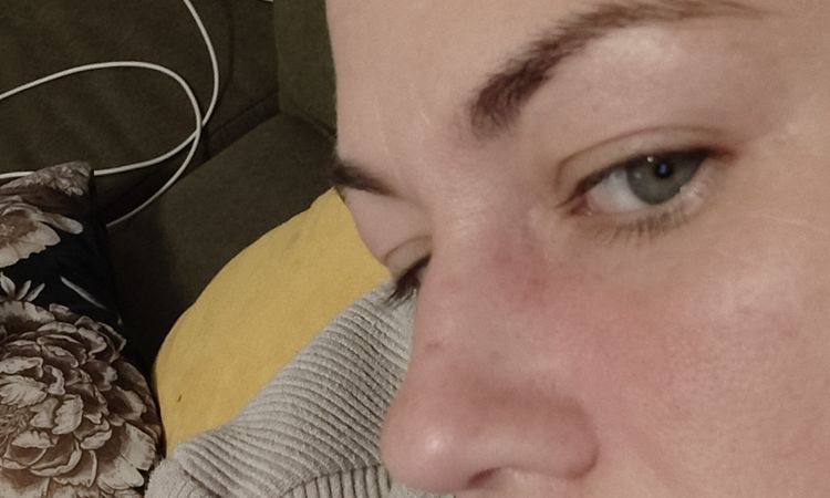 Hyaluronsäure in der Nasialfalten vor 3 Wochen gespritzt - 83075