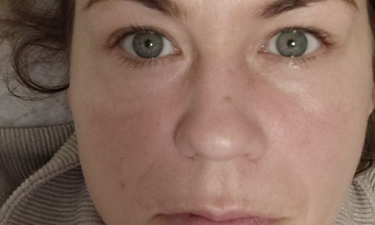 Hyaluronsäure in der Nasialfalten vor 3 Wochen gespritzt - 83076