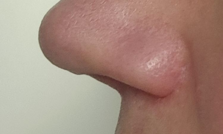 6 Monate nach Nasenkorrektur noch starke Schwellung - 83100