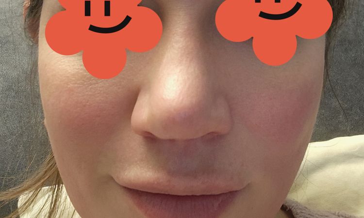 6 Monate nach Nasenkorrektur noch starke Schwellung - 83101