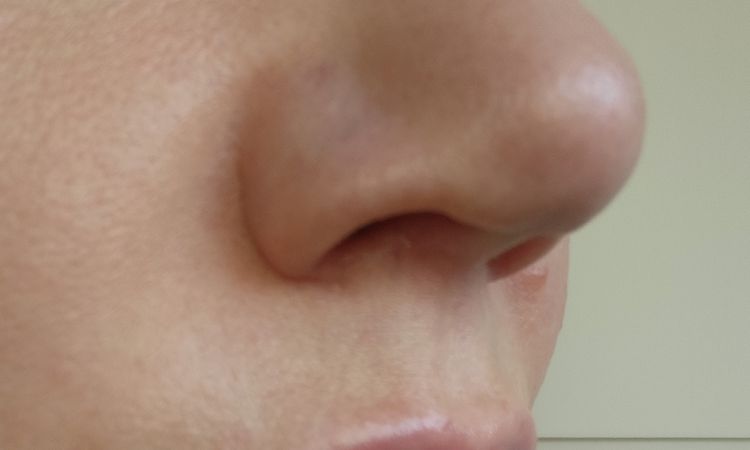 6 Monate nach Nasenkorrektur noch starke Schwellung - 83102