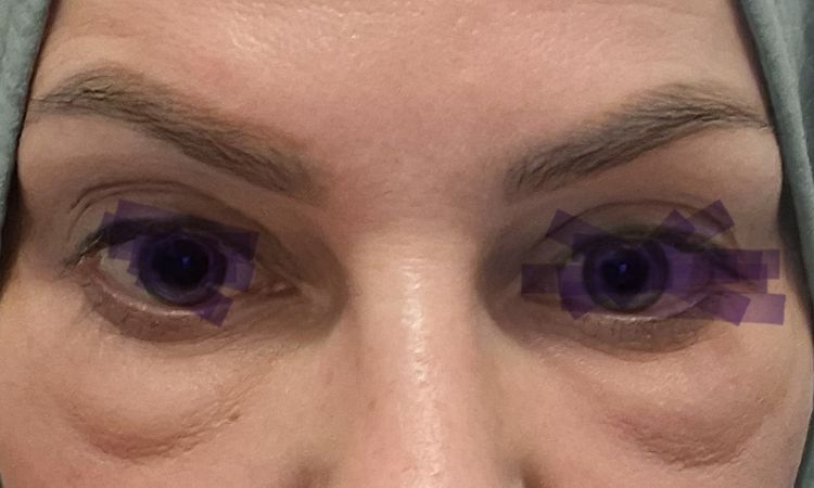 Nach Mesotherpaie unter dem Auge sind die Partien extrem geschwollen. - 83105