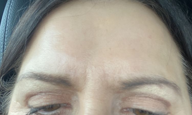 Oberlidstraffung sind Augen unterschiedlich groß - 83150