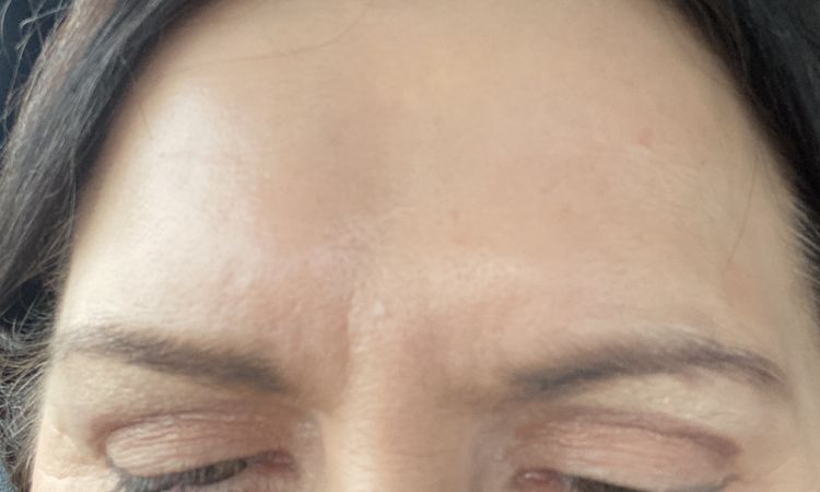 Oberlidstraffung sind Augen unterschiedlich groß - 83151