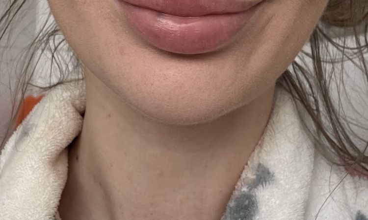 Hyaluron geht trotz hylase nicht raus - 83152