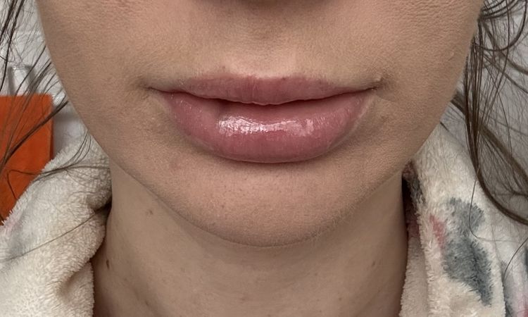 Hyaluron geht trotz hylase nicht raus - 83153