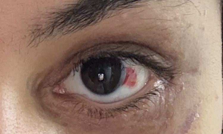 Unterlid hängt nach Unterlidstraffung - 83156