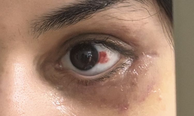 Unterlid hängt nach Unterlidstraffung - 83157