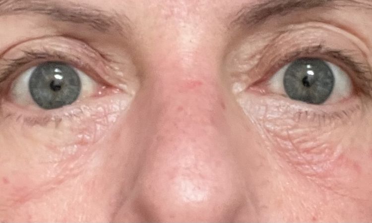 Trotz Op und Laser faltige Unterlider - 83160