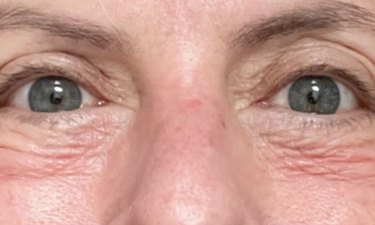 Trotz Op und Laser faltige Unterlider - 83161