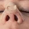 Funktionelle Septorhinoplastik/Septumdeviation