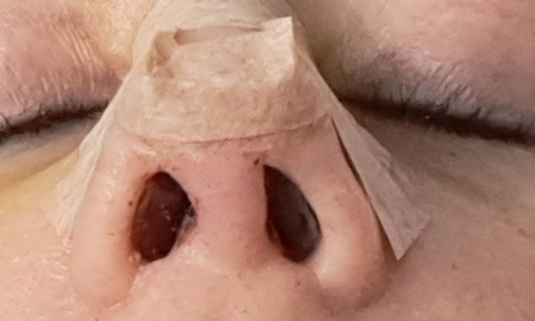 Funktionelle Septorhinoplastik/Septumdeviation - 83177