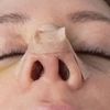 Funktionelle Septorhinoplastik/Septumdeviation