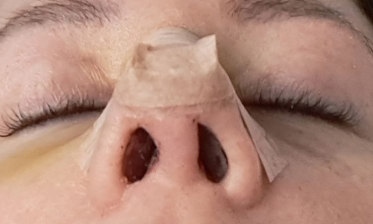 Funktionelle Septorhinoplastik/Septumdeviation - 83178