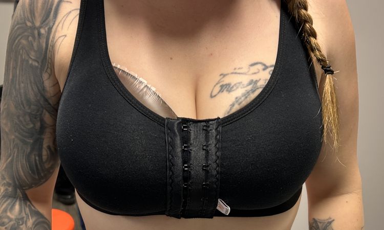 Bekomm ich ein gutes Ergebnis? Brustvergrösserung ohne Straffung - 83194