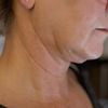 Liposuktion am Kinn/ Hals + Radiofrequenztherapie (Quantum RF) +Morpheus 8