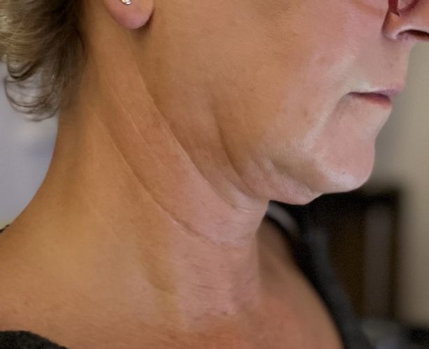 Liposuktion am Kinn/ Hals + Radiofrequenztherapie (Quantum RF) +Morpheus 8