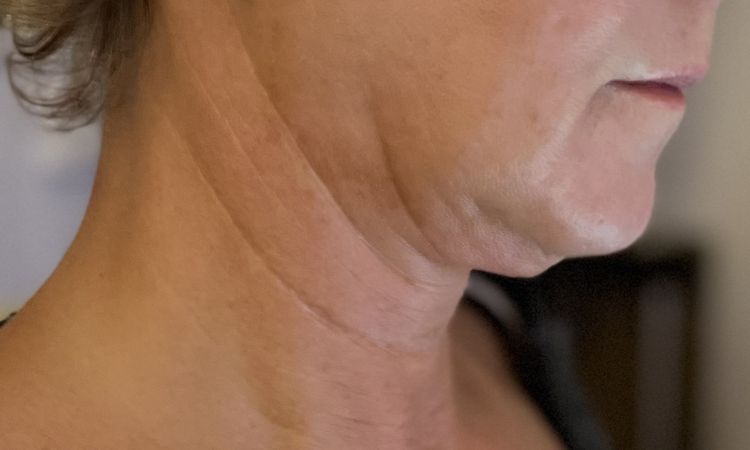 Liposuktion am Kinn/ Hals + Radiofrequenztherapie (Quantum RF) +Morpheus 8 - 83199