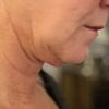 Liposuktion am Kinn/ Hals + Radiofrequenztherapie (Quantum RF) +Morpheus 8