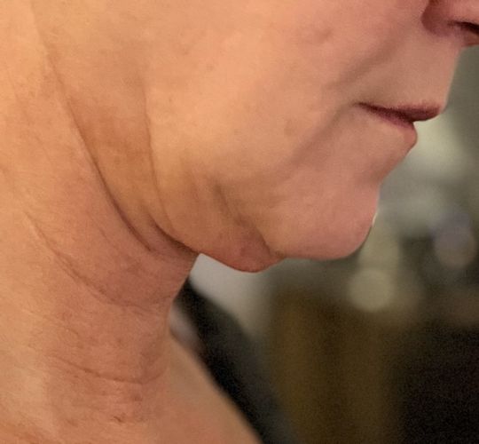 Liposuktion am Kinn/ Hals + Radiofrequenztherapie (Quantum RF) +Morpheus 8