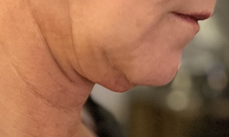 Liposuktion am Kinn/ Hals + Radiofrequenztherapie (Quantum RF) +Morpheus 8 - 83200