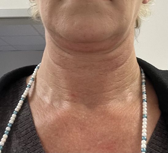 Liposuktion am Kinn/ Hals + Radiofrequenztherapie (Quantum RF) +Morpheus 8