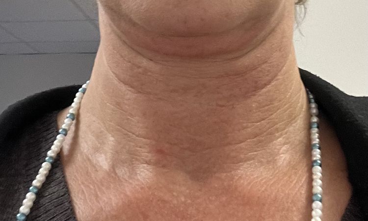 Liposuktion am Kinn/ Hals + Radiofrequenztherapie (Quantum RF) +Morpheus 8 - 83201