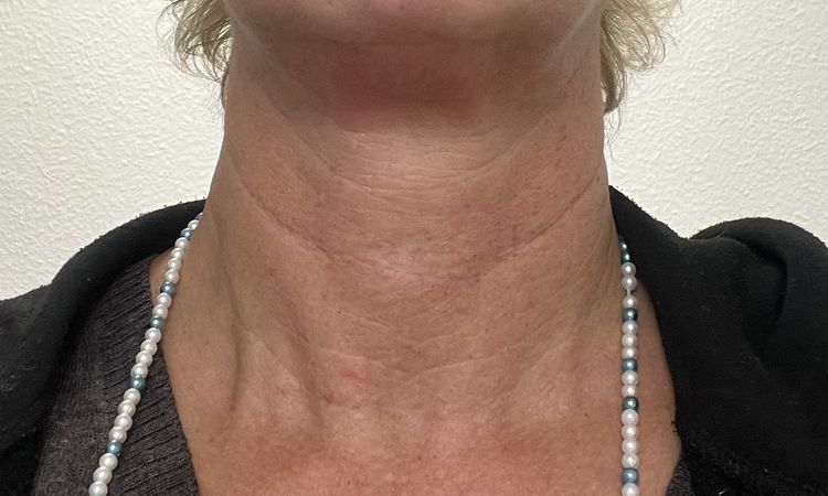 Liposuktion am Kinn/ Hals + Radiofrequenztherapie (Quantum RF) +Morpheus 8 - 83202